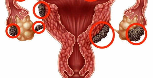 Ketahui Tentang Penyakit Endometriosis